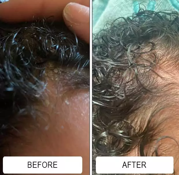 Cradle cap flakes in a baby's textured hair before and after using Happy Cappy medicated shampoo