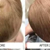 Baby scalp with cradle cap before, and clear after two weeks of the Happy Cappy medicated routine