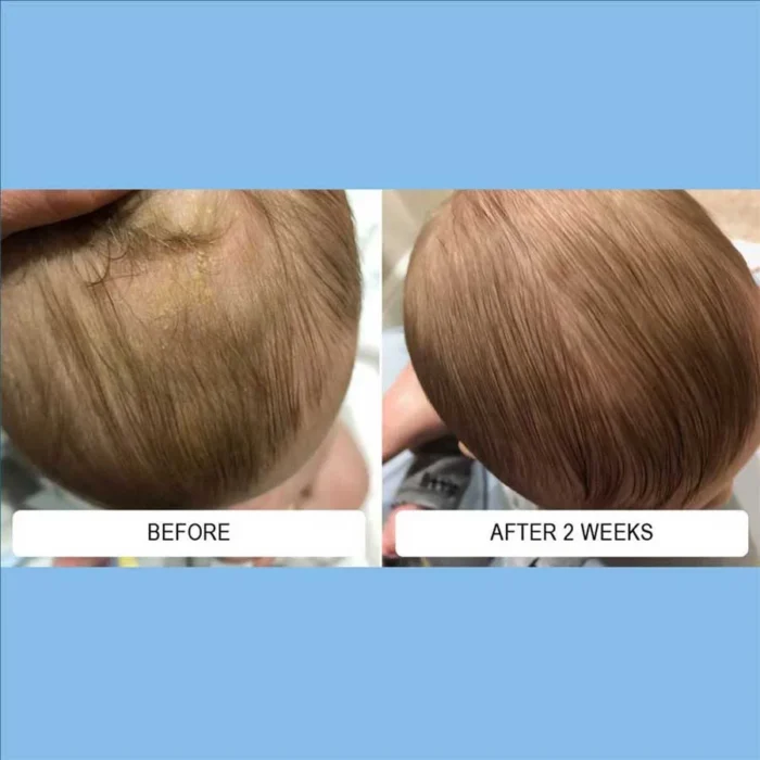 A baby's cradle cap with greasy scalp flaking before and after two weeks of Happy Cappy medicated shampoo