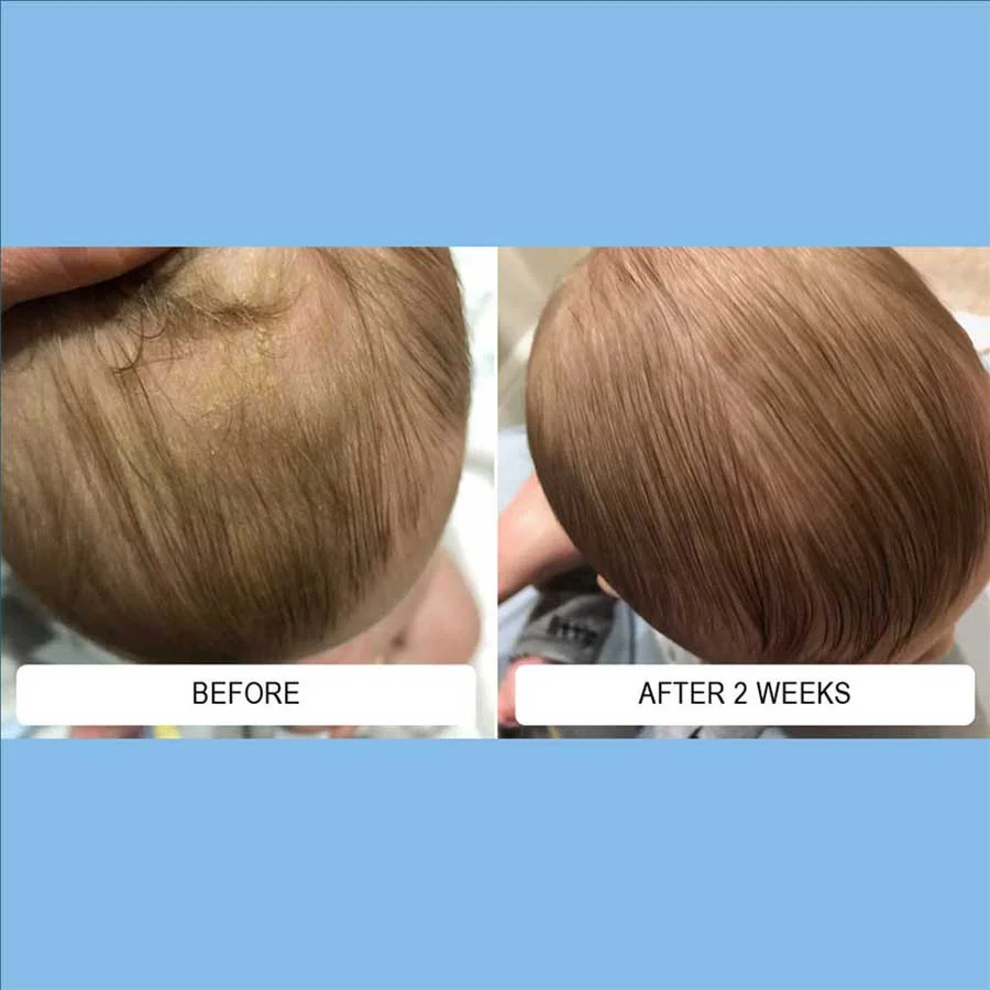 Scalp flaking over time in before-and-after photographs