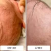 White cradle cap flakes across a baby's scalp before and a clear scalp after Happy Cappy medicated shampoo