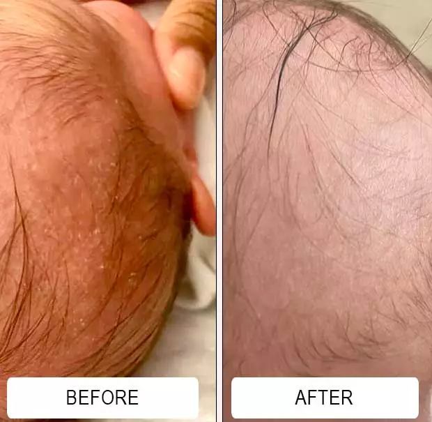 White cradle cap flakes across a baby's scalp before and a clear scalp after Happy Cappy medicated shampoo