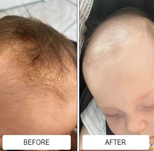 Greasy yellow cradle cap flakes on a baby's hairline before and after Happy Cappy medicated shampoo