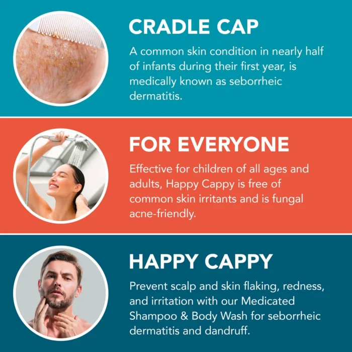 Explainer, cradle cap is seborrheic dermatitis, the medicated shampoo suits all ages and is fungal acne friendly