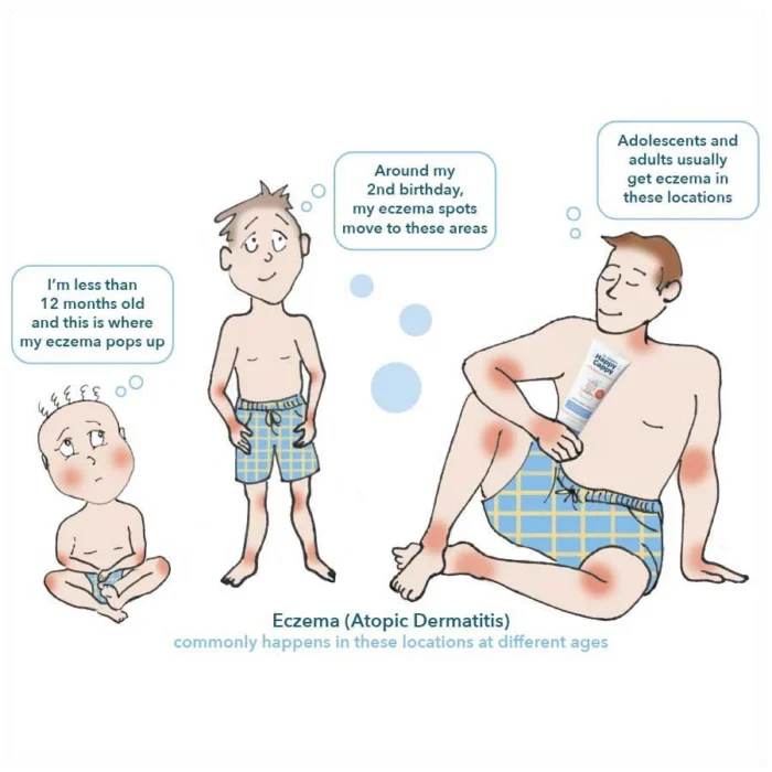 Cartoon of where eczema, atopic dermatitis, tends to appear on a baby, a child and an adult