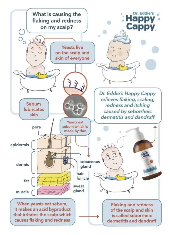 Diagram of what causes scalp flaking and redness, yeast and sebum, with Happy Cappy for seborrheic dermatitis and dandruff