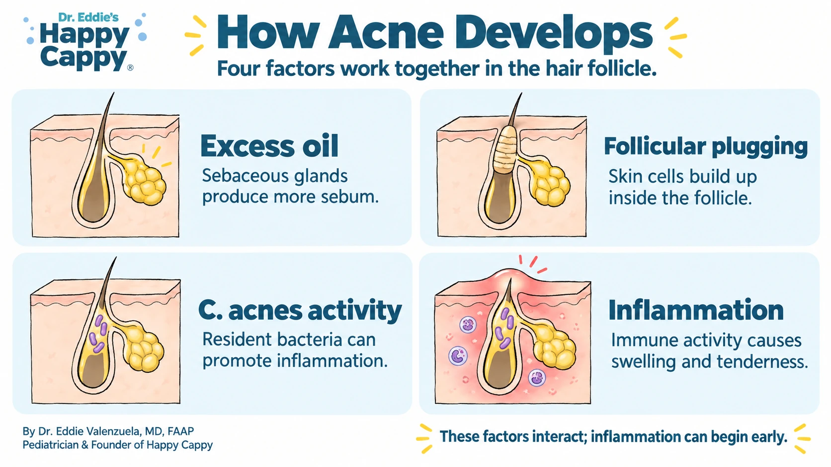 Four factors in acne: excess oil, follicular plugging, Cutibacterium acnes activity and inflammation.