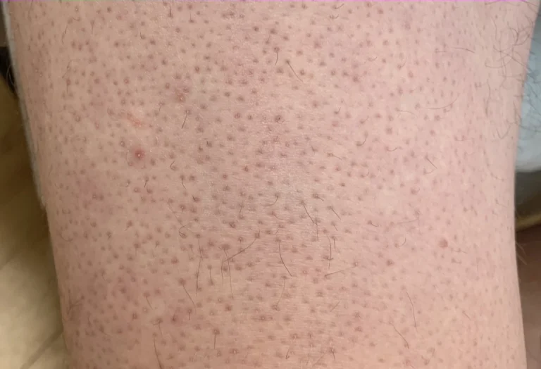 Small follicular bumps of keratosis pilaris on a leg
