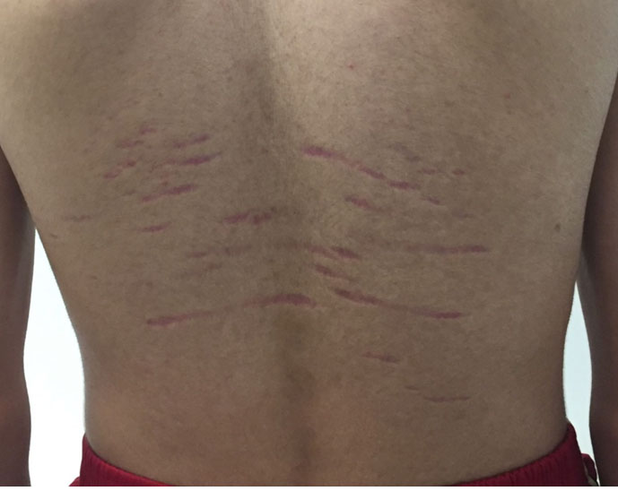 Clinical photograph showing multiple horizontal purple stretch marks across a 14-year-old boy’s back.
