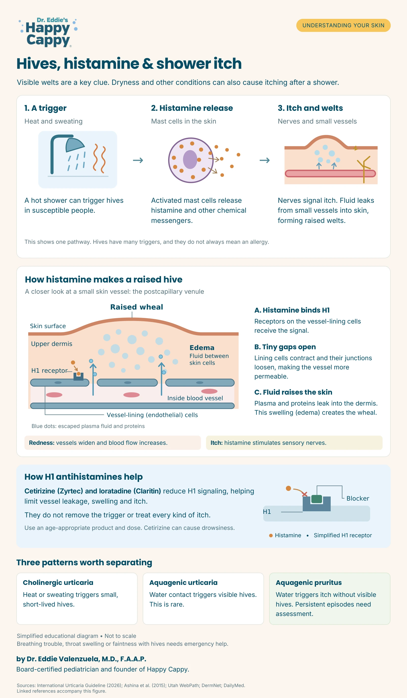 Histamine activates H1 receptors on vessel-lining cells, opening gaps that let plasma enter the dermis and raise a hive; includes redness, itch, H1 antihistamine action and three shower-itch patterns.