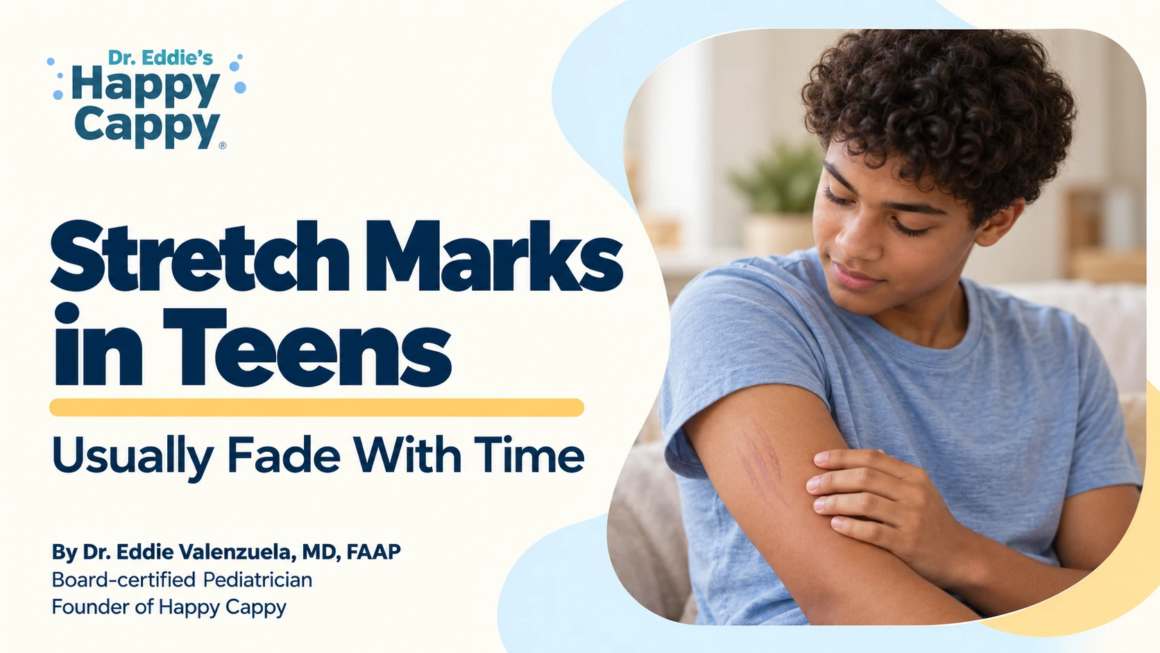 Stretch Marks in Teens Usually Fade With Time