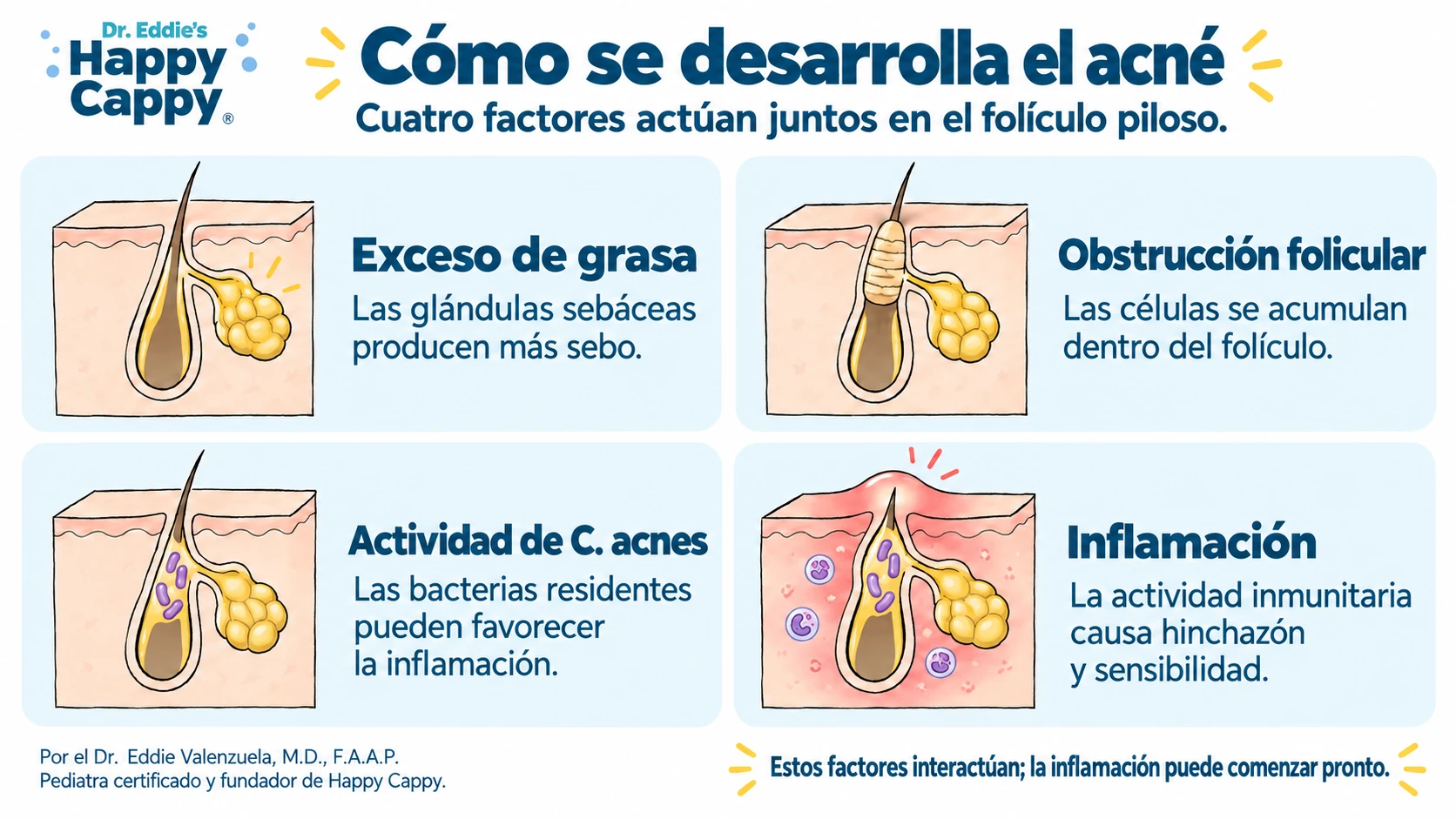 Cuatro factores del acné: exceso de grasa, obstrucción folicular, actividad de Cutibacterium acnes e inflamación.