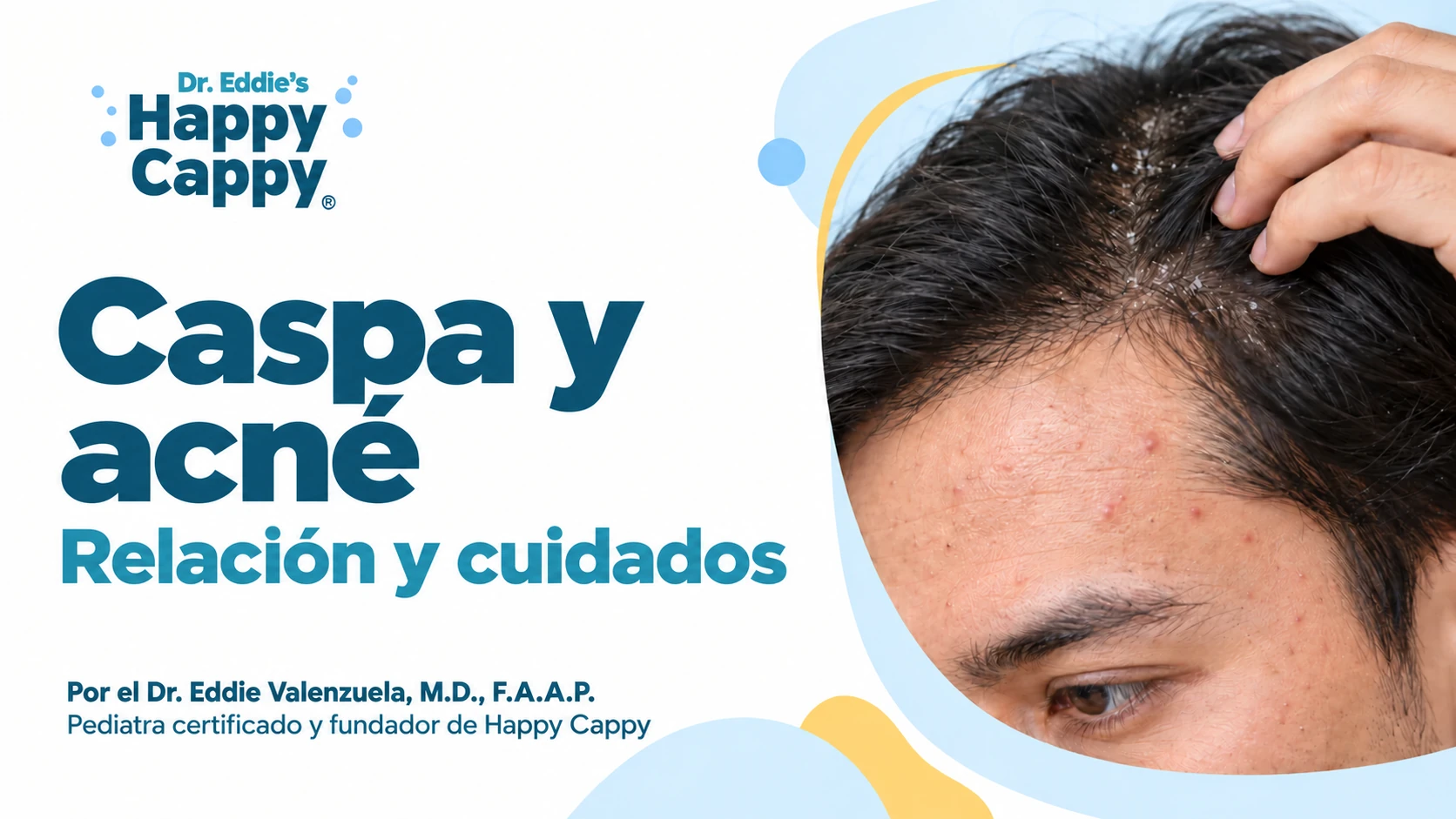 Persona con escamas en el cuero cabelludo y granitos en la frente junto al título «Caspa y acné: relación y cuidados».