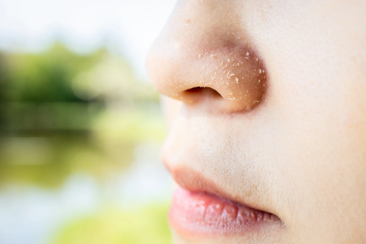 Close-up showing flakes on the skin beside the nose.