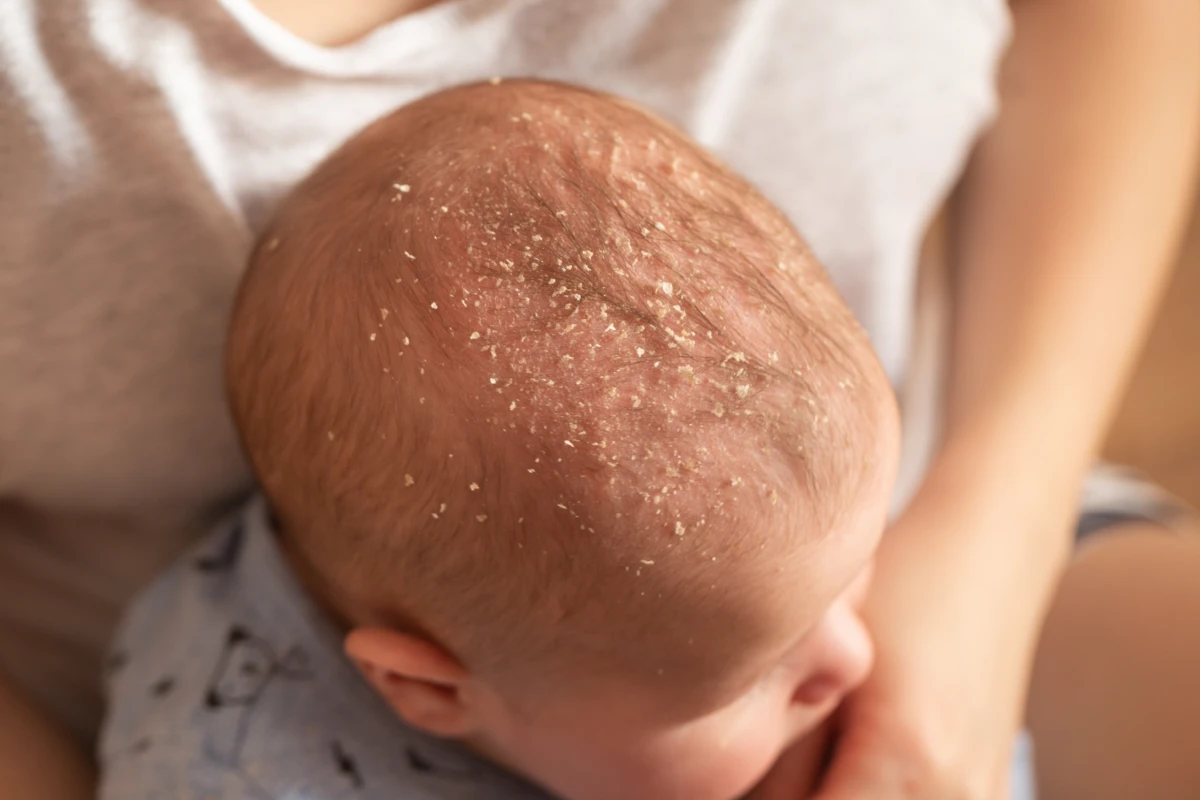Infant scalp with visible yellowish flakes across the top of the head.