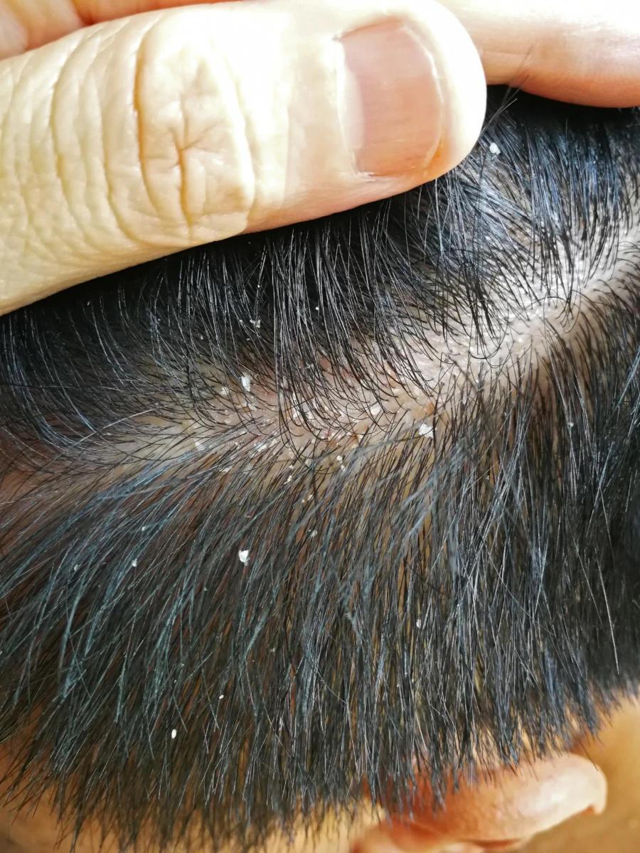 Close-up of parted dark hair showing flakes on the scalp and hair.