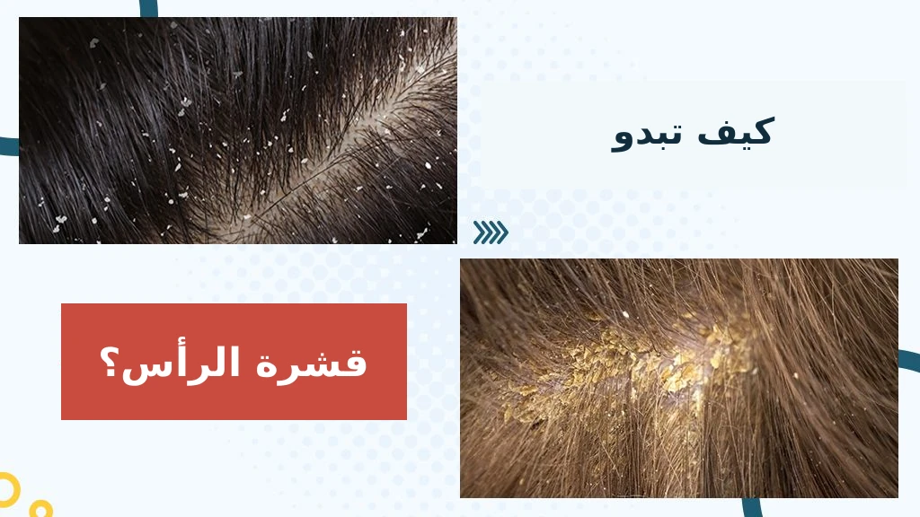 قشيرات بيضاء سائبة وقشور صفراء أكثر سماكة من فروة الرأس، جنبًا إلى جنب.