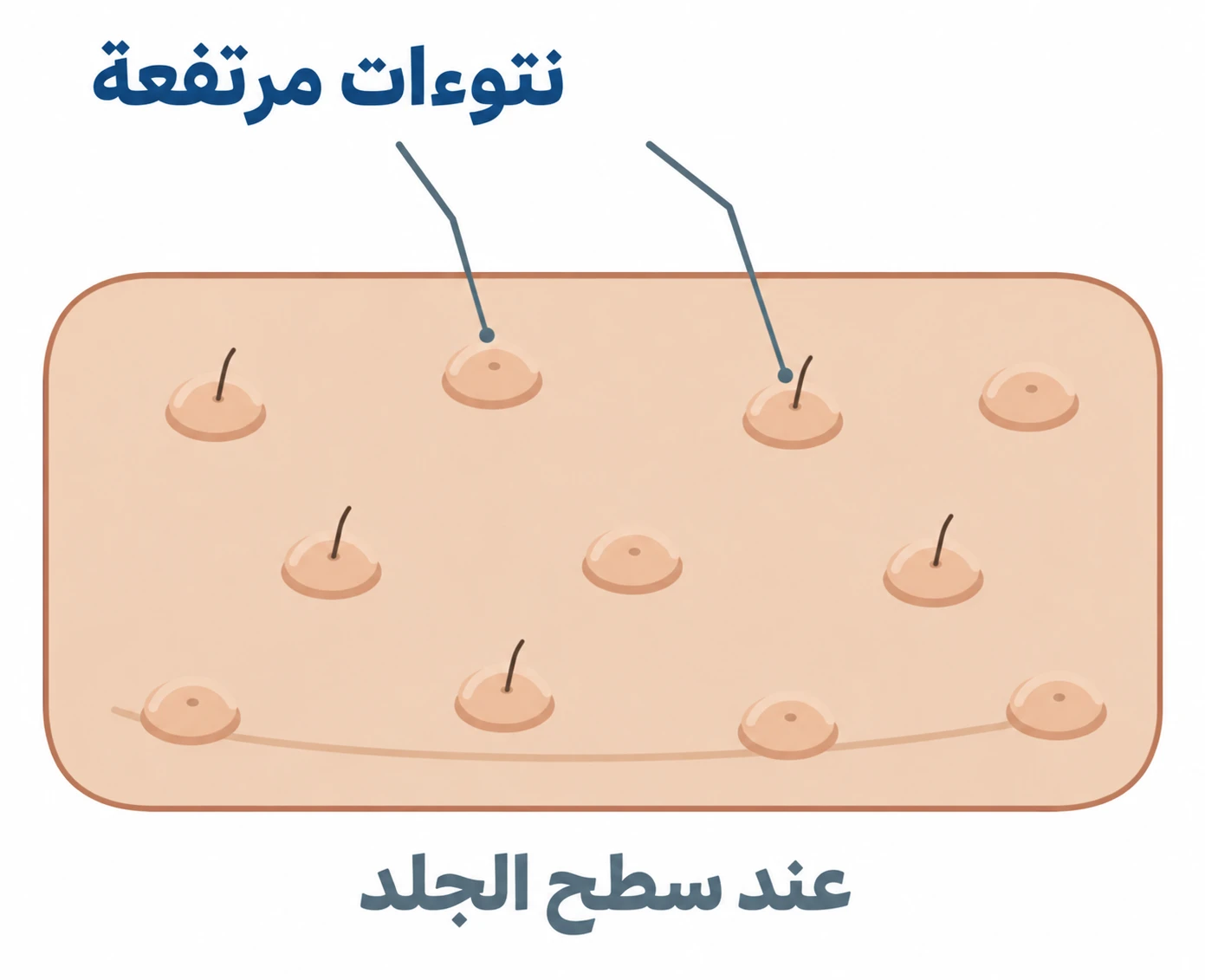 رسم مبسط لسطح الجلد مع نتوءات صغيرة مرتفعة تتمركز عند فتحات بصيلات الشعر.