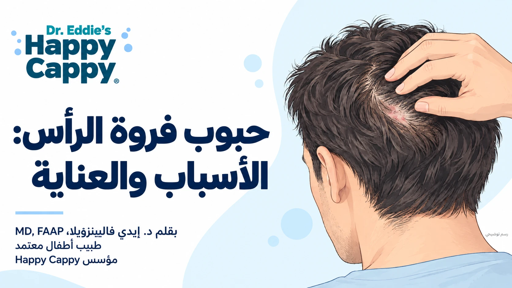 رسم لشخص بالغ يفرق شعره القصير لفحص حبوب فروة الرأس.