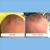 Before and after pictures of babies who've used cradle cap shampoo